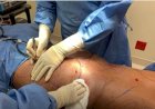 New audit reveals 44% rise in botched cosmetic surgery abroad