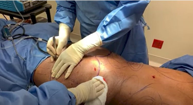 New audit reveals 44% rise in botched cosmetic surgery abroad